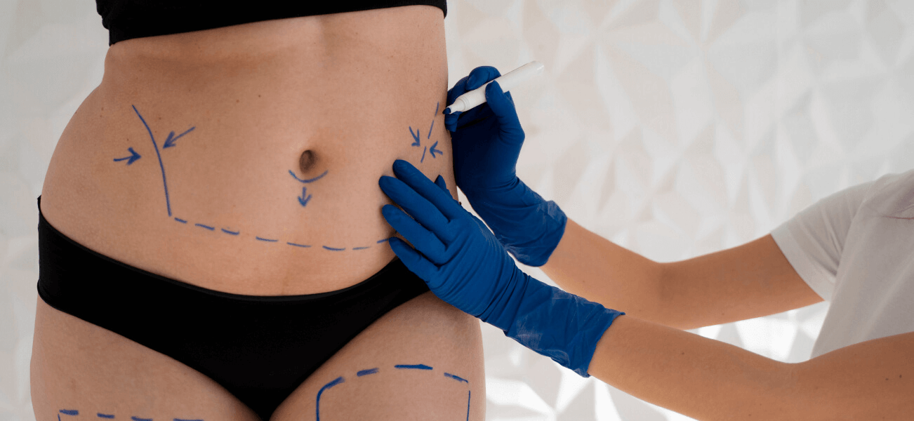 Stomach liposuction for a sculpted look